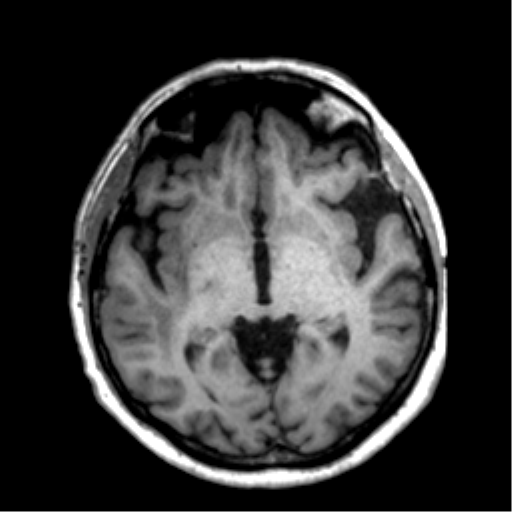 Anaplastic astrocytoma IDH wild-type (pseudoprogression) (Radiopaedia 42209-45277 Axial T1 61).png