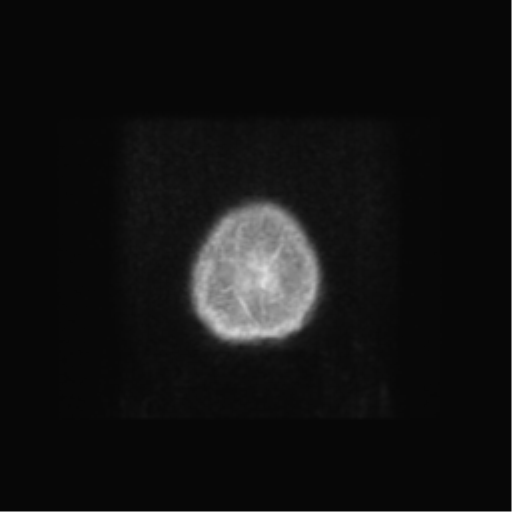 Anaplastic astrocytoma IDH wild-type (pseudoprogression) (Radiopaedia 42209-45279 Axial T1 C+ 148).png