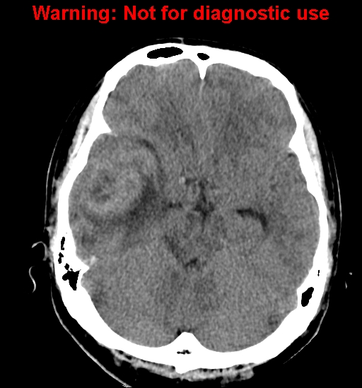 File:Anaplastic ganglioglioma (Radiopaedia 44921-48815 Axial non-contrast 9).jpg