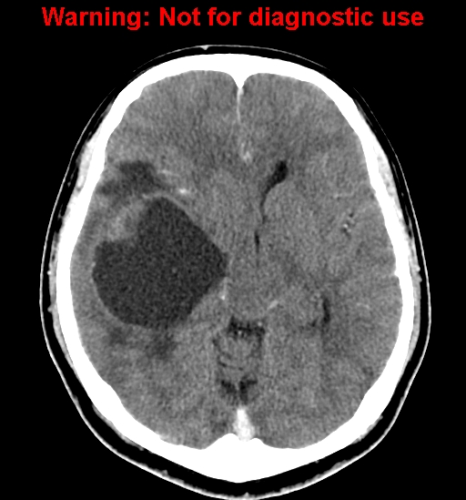 File:Anaplastic ganglioglioma (Radiopaedia 44921-48815 B 13).jpg