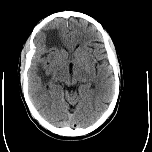 File:Anaplastic meningioma with recurrence (Radiopaedia 34452-35781 Axial non-contrast 15).png