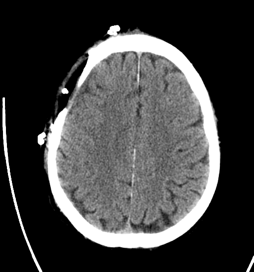 File:Anaplastic meningioma with recurrence (Radiopaedia 34452-35786 Axial non-contrast 23).png