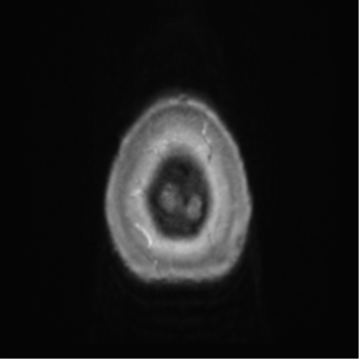 Anaplastic oligodendroglioma (Radiopaedia 83500-98599 Axial T1 C+ 75).png