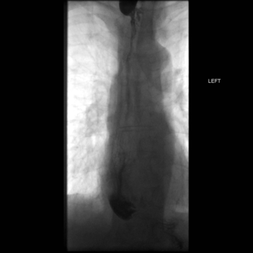 File:Anastomotic stricture post Ivor Lewis esophagectomy (Radiopaedia 47937-52715 B 44).png