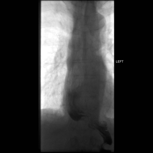File:Anastomotic stricture post Ivor Lewis esophagectomy (Radiopaedia 47937-52715 C 9).png