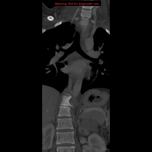 File:Aneurysmal bone cyst (Radiopaedia 9419-10102 Coronal bone window 3).jpg