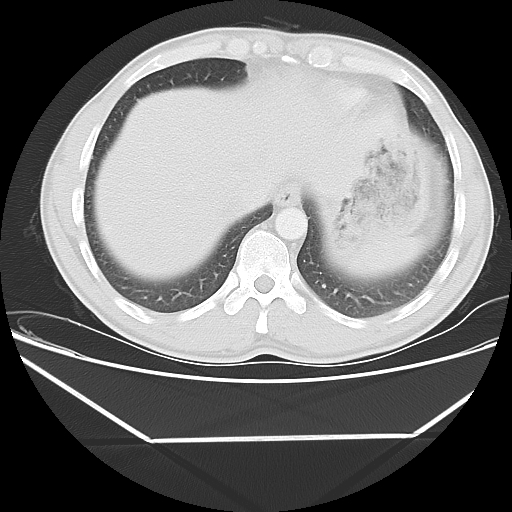 File:Aneurysmal bone cyst - rib (Radiopaedia 82167-96220 Axial lung window 53).jpg
