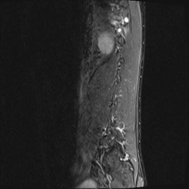 File:Aneurysmal bone cyst T11 (Radiopaedia 29294-29720 Sagittal STIR 15).jpg