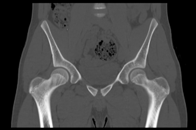 File:Aneurysmal bone cyst of ischium (Radiopaedia 25957-26094 Coronal bone window 15).png