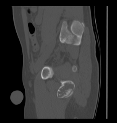 Aneurysmal bone cyst of ischium (Radiopaedia 25957-26094 Sagittal bone window 49).png