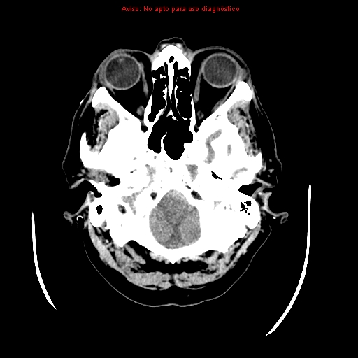 File:Aneurysmal subarachnoid hemorrhage (Radiopaedia 24740-24997 Axial non-contrast 6).jpg