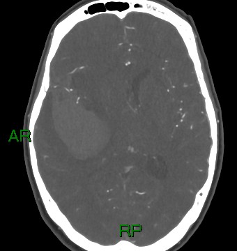 File:Aneurysmal subarachnoid hemorrhage with intra-axial extension (Radiopaedia 84371-99732 A 20).jpg