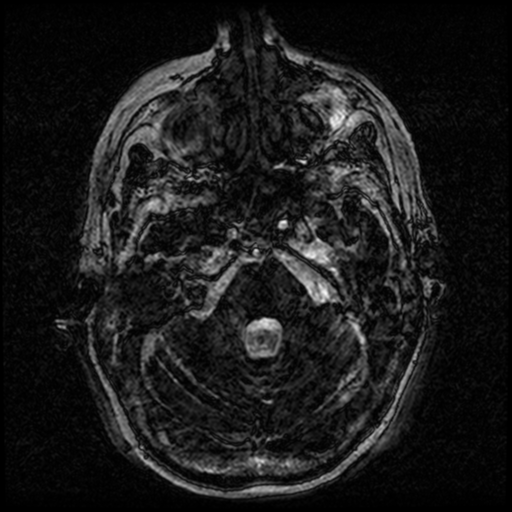 Angioinvasive aspergillosis in the pituitary fossa (Radiopaedia 39676-42010 Ax 3D FIESTA VOLUME 21).png