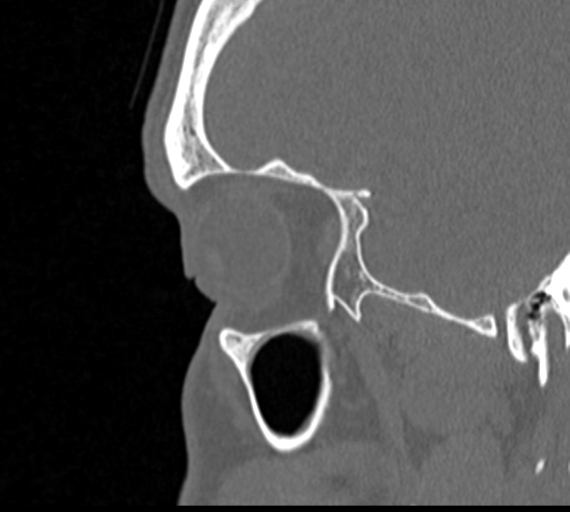 Angular epidermoid cyst (Radiopaedia 46908-51439 Sagittal bone window 11).png