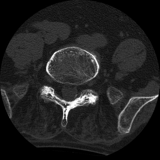 Ankylosing spondylitis complicated by fracture-dislocation (Radiopaedia 33583-34674 Axial non-contrast 133).jpg