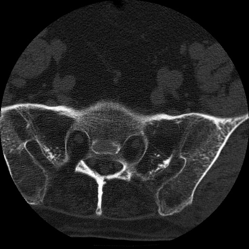 Ankylosing spondylitis complicated by fracture-dislocation (Radiopaedia 33583-34674 Axial non-contrast 162).jpg