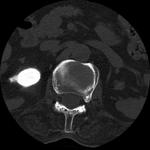 Ankylosing spondylitis complicated by fracture-dislocation (Radiopaedia 33583-34674 Axial non-contrast 27).jpg