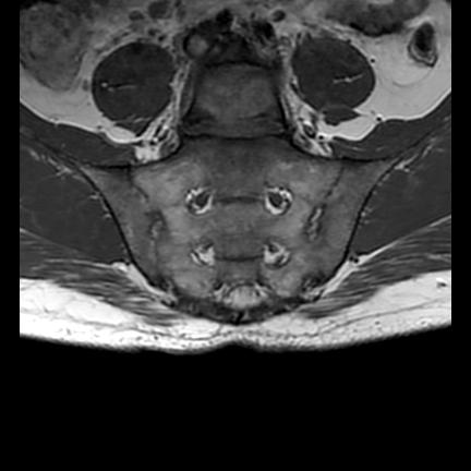 File:Ankylosing spondylitis with zygapophyseal arthritis (Radiopaedia 38433-40517 E 6).jpg