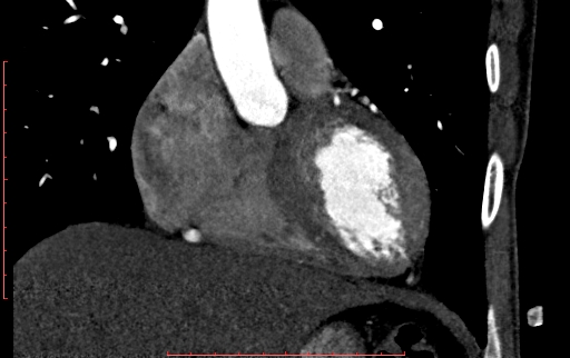 Anomalous left coronary artery from the pulmonary artery (ALCAPA) (Radiopaedia 70148-80181 B 109).jpg