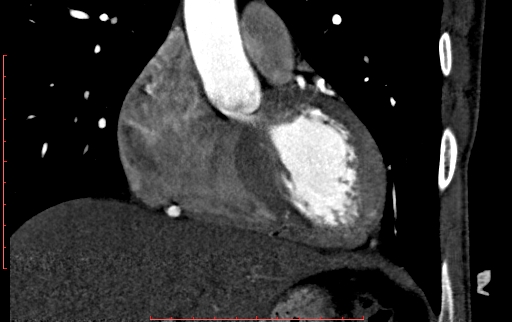 Anomalous left coronary artery from the pulmonary artery (ALCAPA) (Radiopaedia 70148-80181 B 115).jpg