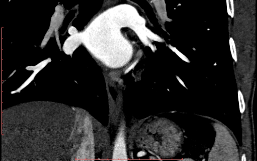 Anomalous left coronary artery from the pulmonary artery (ALCAPA) (Radiopaedia 70148-80181 B 226).jpg