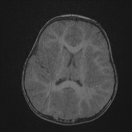 Anoxic brain injury (Radiopaedia 79165-92139 Axial MRA 152).jpg