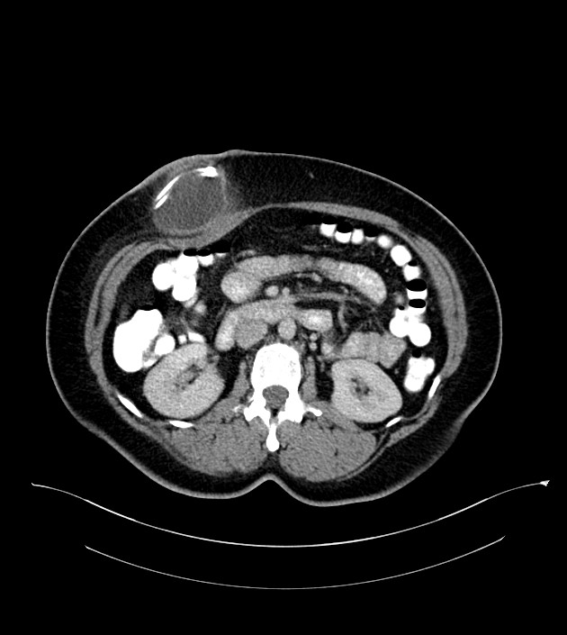 Anterior abdominal wall CSF pseudocyst (CSFoma) (Radiopaedia 79453-92571 A 41).jpg