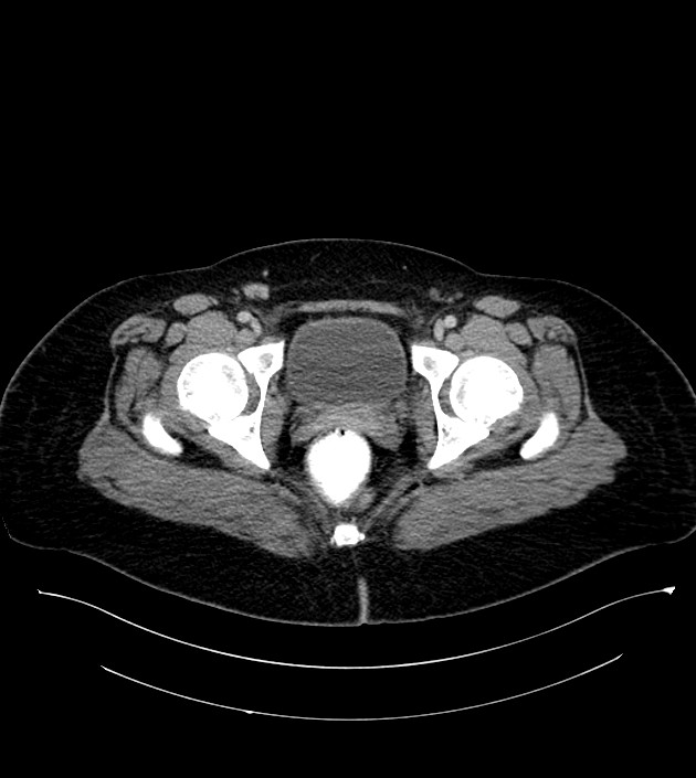 Anterior abdominal wall CSF pseudocyst (CSFoma) (Radiopaedia 79453-92571 A 88).jpg