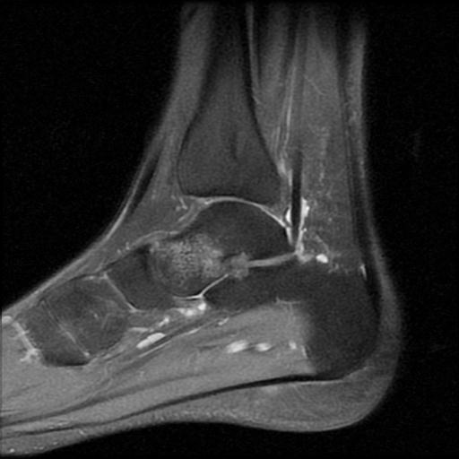 File:Anterior calcaneal process fracture (Radiopaedia 71377-81705 Sagittal PD fat sat 11).jpg