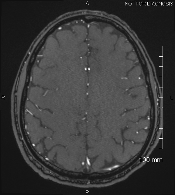 Anterior cerebral artery aneurysm (Radiopaedia 80683-94127 Axial MRA 184).jpg