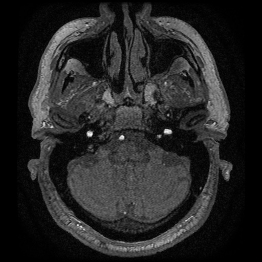 Anterior cerebral artery infarction (Radiopaedia 46794-51323 Axial MRA 13).jpg