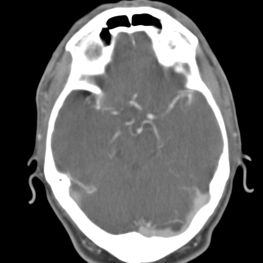 Anterior cerebral artery territory infarct (Radiopaedia 39327-41581 B 37).png
