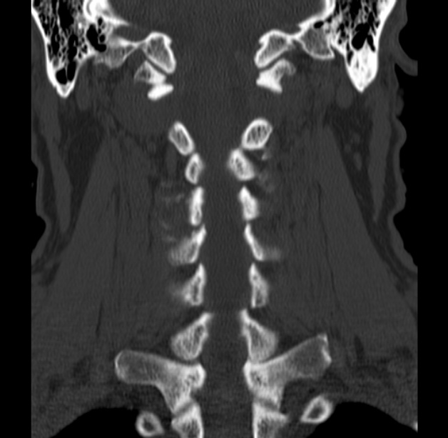 Anterior cervical postdiscectomy arthrodesis (Radiopaedia 32678-33646 Coronal bone window 41).jpg