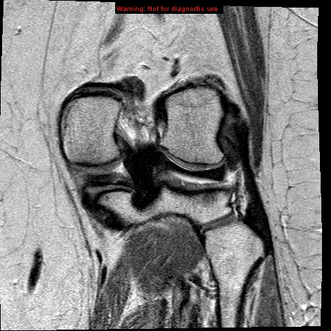 File:Anterior cruciate ligament tear - complete (Radiopaedia 12175-12514 C 17).jpg