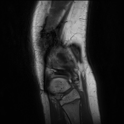 Anterior cruciate ligament tear - pediatric (Radiopaedia 62152-70260 Sagittal PD 153).jpg