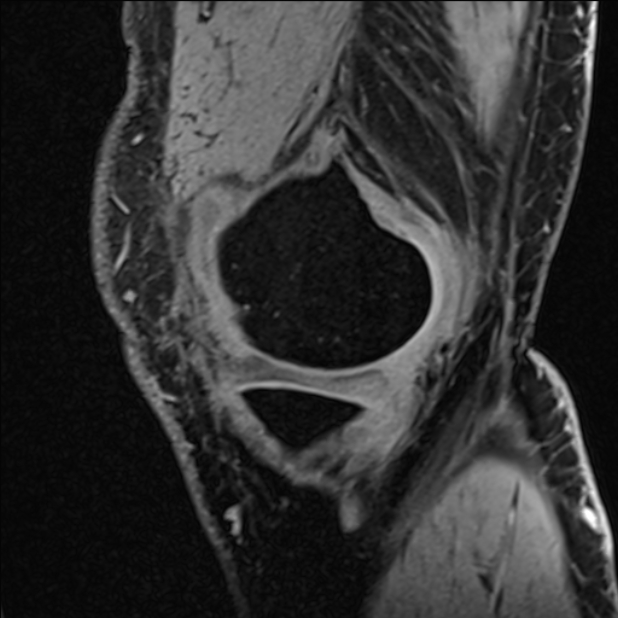 Anterior cruciate ligament tear - ramp lesion (Radiopaedia 71883-82322 Sagittal T1 vibe 115).jpg