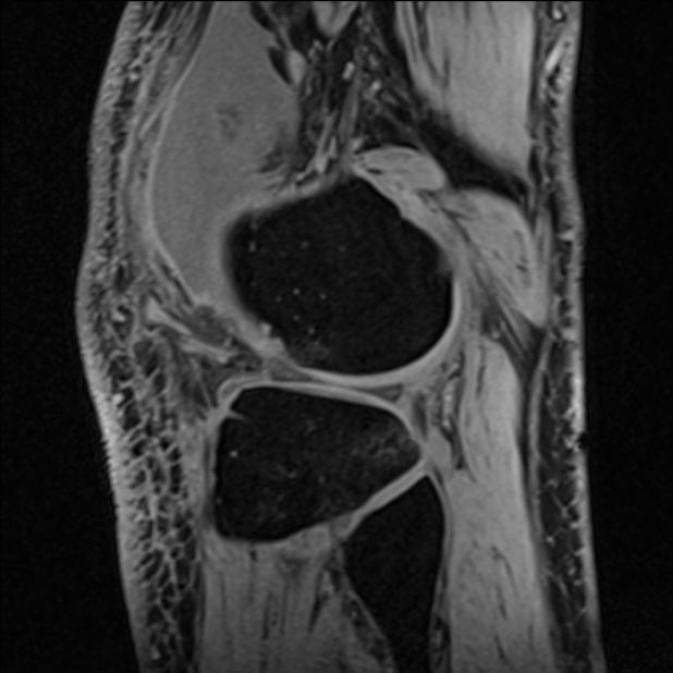 Anterior cruciate ligament tear - ramp lesion (Radiopaedia 71883-82322 Sagittal T1 vibe 32).jpg