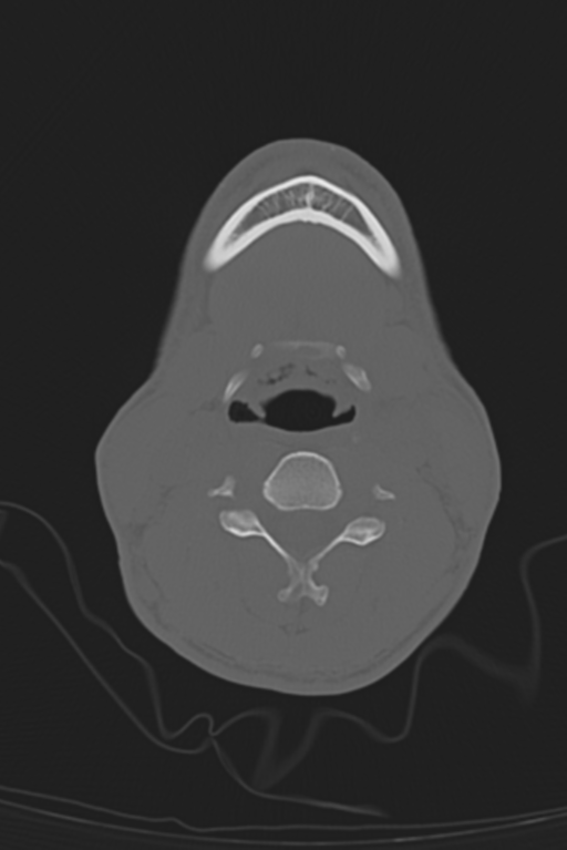 Anterior nasal spine fracture (Radiopaedia 46138-50494 Axial bone window 78).png