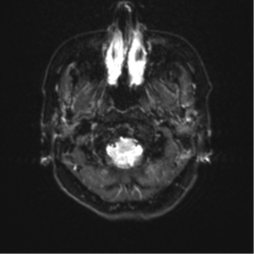 Anterior temporal lobe perivascular space (Radiopaedia 40946-43650 Axial DWI 1).png