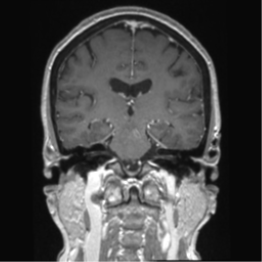 Anterior temporal pole cysts (Radiopaedia 46629-51102 Coronal T1 C+ 79).png