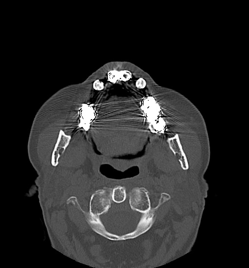 Anterior temporomandibular joint dislocation (Radiopaedia 59430-66784 Axial non-contrast 31).jpg