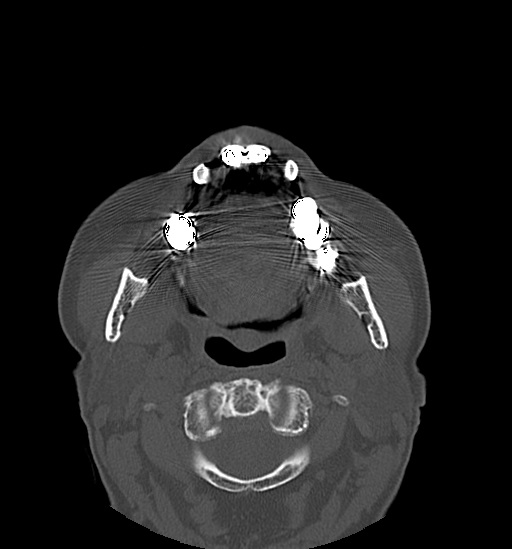 Anterior temporomandibular joint dislocation (Radiopaedia 59430-66784 Axial non-contrast 32).jpg