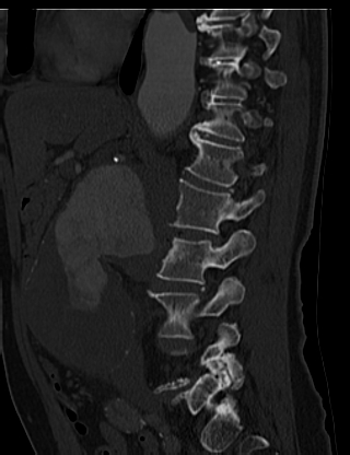 File:Anterior vertebral scalloping (abdominal aortic aneurysm) (Radiopaedia 66744-76067 Sagittal bone window 15).jpg