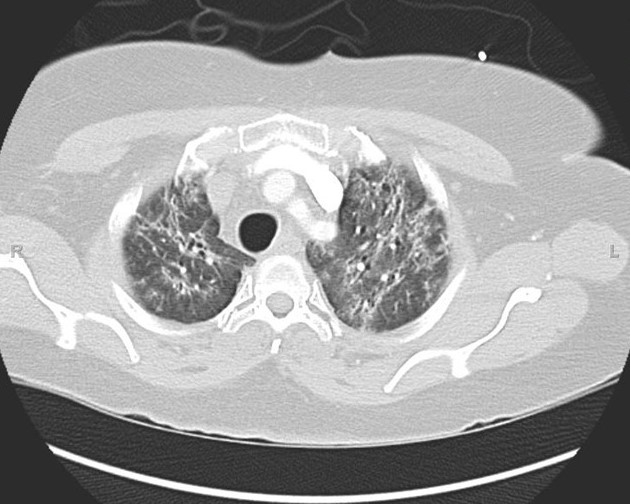 Anti-synthetase syndrome (anti-Jo1) (Radiopaedia 31899-32846 Axial lung window 9).JPG