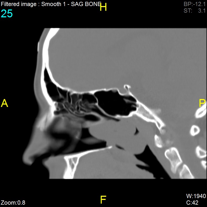 Antrochoanal polyp (Radiopaedia 65101-74094 Sagittal bone window 25).jpg