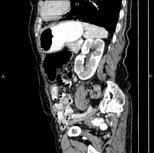 Aortic aneurysm and Lemmel syndrome (Radiopaedia 86499-102554 D 63).jpg