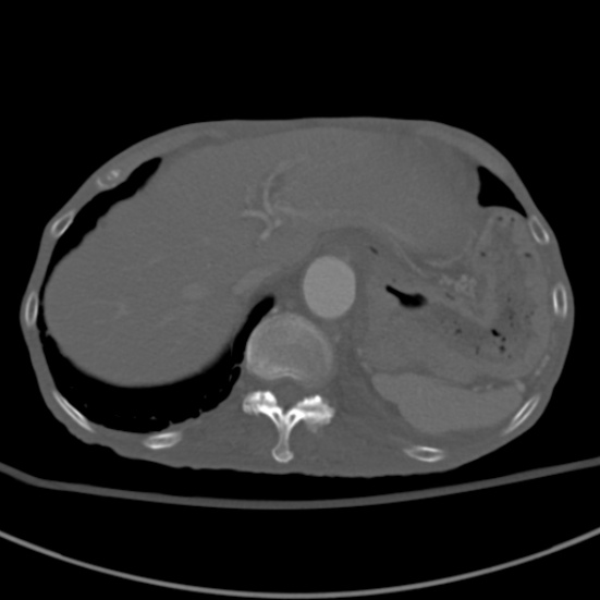 Aortic aneurysm with spinal destruction (Radiopaedia 42301-45410 Axial bone window 17).jpg
