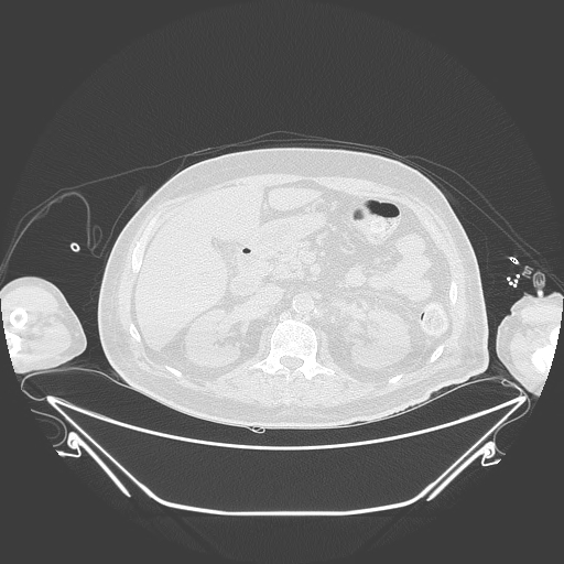 Aortic arch aneurysm (Radiopaedia 84109-99365 Axial lung window 320).jpg