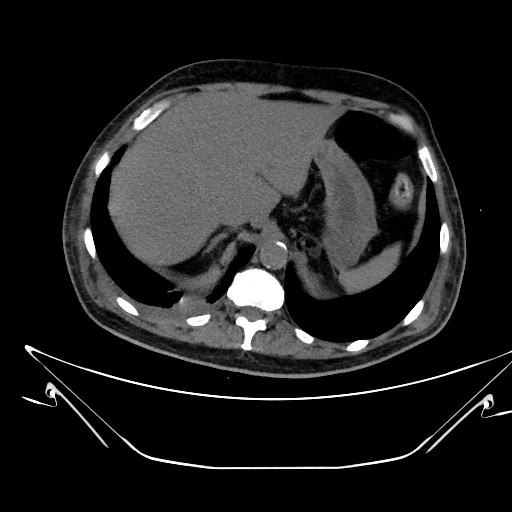 Aortic arch aneurysm (Radiopaedia 84109-99365 Axial non-contrast 262).jpg