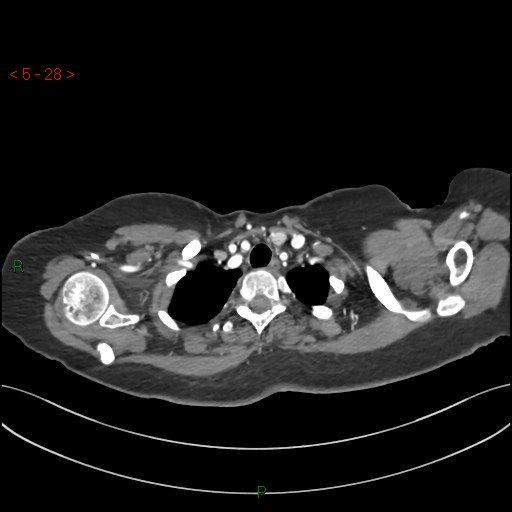 Aortic arch origin of left vertebral artery (Radiopaedia 51520-57286 A 27).jpg